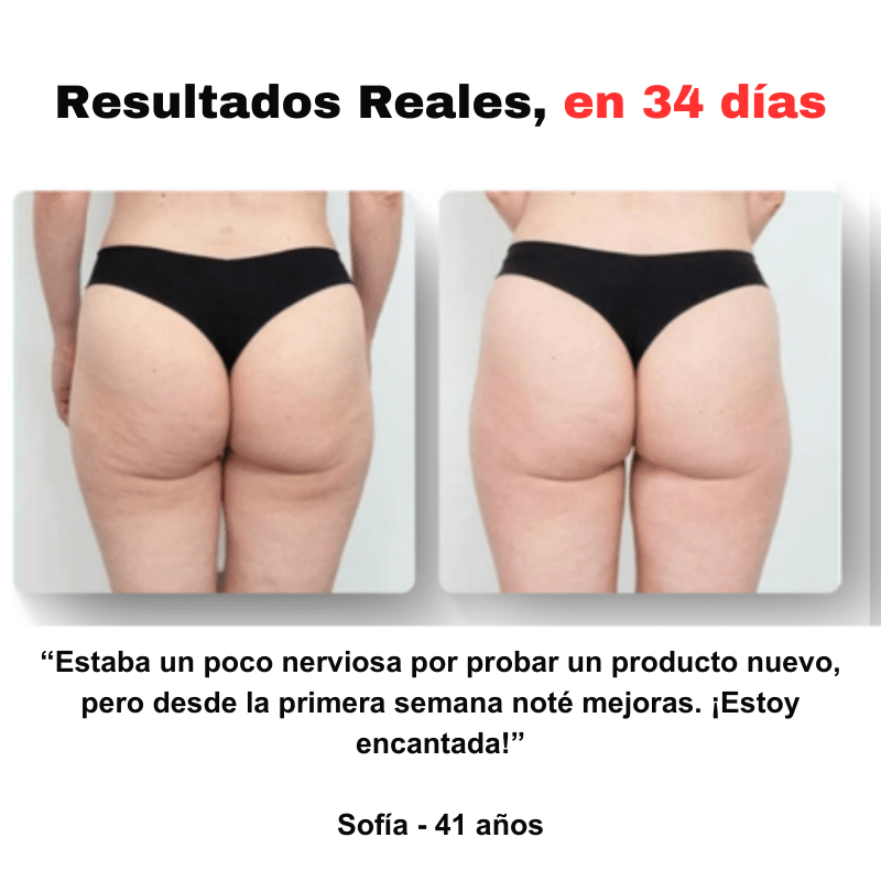 ¡Última oportunidad! Esta oferta expira en 2 horas - SmoothGlow™ - Masajeador anticelulítico
